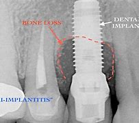 Image result for Implant Bone Loss