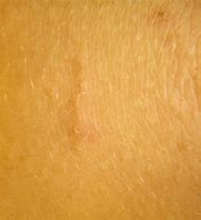Image result for Scabies