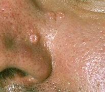 Image result for Sebaceous Gland Hyperplasia