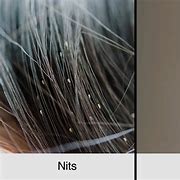 Image result for What Does Bad Lice Look Like
