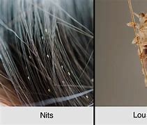Image result for What Does Lice Look Like When Dead