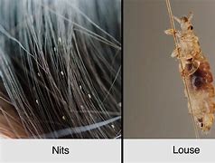 Image result for What Does Lice Look Like in Hair