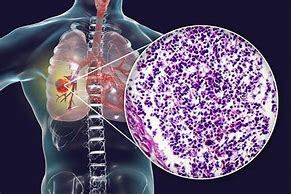 Image result for Advanced Lung Cancer