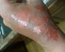 Image result for 2nd Degree Burn From Sun