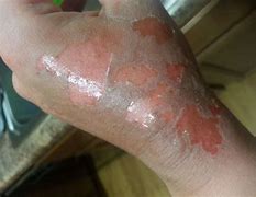 Image result for Burn Blister On Wrist Photo
