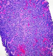 Image result for Atypical Carcinoid