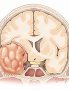 Image result for Meningioma Brain Tumors 1 Cm