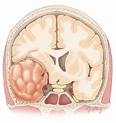 Image result for Left Temporal Meningioma