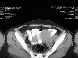Image result for Functional Ovarian Cyst