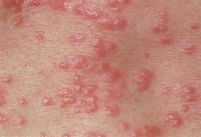 Image result for 10 Common Rashes Skin Chart