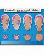 Image result for Cervical Dilation Chart Plastic