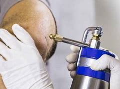 Image result for Cryotherapy Condyloma