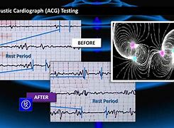 Image result for cardiovraf�a