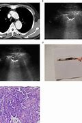 Image result for Needle Biopsy Lung Nodule