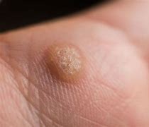 Image result for Wart Has Water