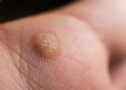 Image result for What Is a Filiform Wart