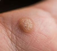 Image result for Types of Warts On Arm
