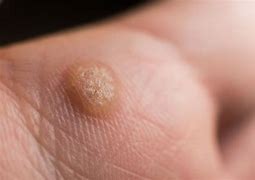 Image result for Human Papillomavirus Flat Warts
