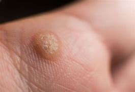 Image result for Wart On My Arm