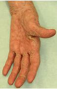 Image result for Crusted Scabies Rash