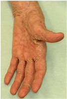 Image result for Itchy Skin Scabies