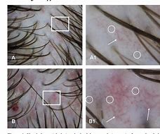 Image result for Dermatitis Eczema Seborrheic Contect