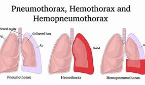hemothorax 的图像结果
