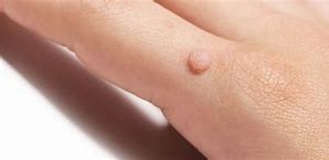 Image result for Pics of Warts On Face