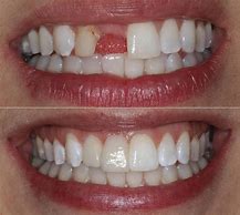Image result for Front Teeth