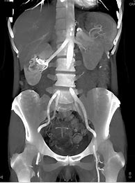 Image result for Complex Renal Cyst