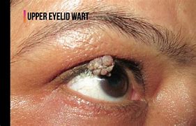 Image result for Annoying Wart On Eyelid