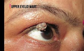 Image result for Wart On Eyelid