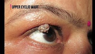 Image result for Warts around Eyes
