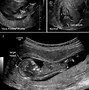 Image result for Frog Sign Anencephaly