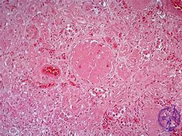 Image result for Nephrosclerosis