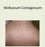 Image result for Molluscum Contagiosum Treatment Podofilox