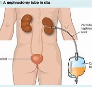 Image result for Sleeping with a Nephrostomy Bag