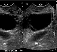 Image result for 3 Cm Cyst On Ovary