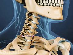 Image result for Cervical Spine Disc Replacement