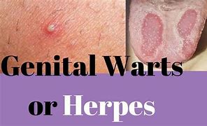 Image result for Salicylic Acid for Wart Behindd Head