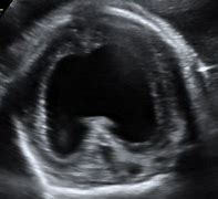Image result for Holoprosencephaly On Ultrasound