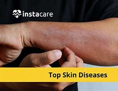 Image result for Common Skin Diseases Humans