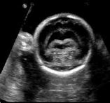 Image result for Semilobar Holoprosencephaly Ultrasound