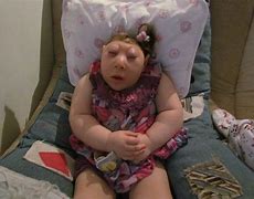 Image result for Oldest Living Baby with Anencephaly