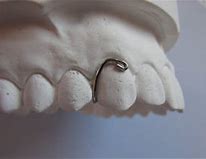 Image result for C Clasp Joint Mechanical Clip On and Off