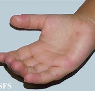 Image result for Hand Foot Mouth Disease