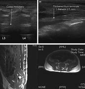 Image result for Occult Spinal Dysraphism