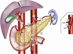 Image result for Pancreatic Cancer Lymph Nodes