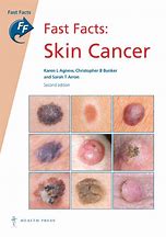 Image result for Skin Cancer Identification Chart