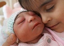 Image result for Anencephaly Baby Survives